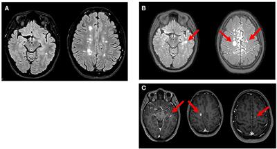 Severe Multiple Sclerosis Relapse After COVID-19 Vaccination: A Case Report